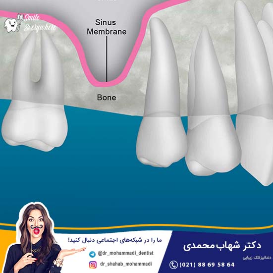 لیفت سینوس چیست  و چه ارتباطی با کاشت ایمپلنت دارد؟ - کلینیک دندانپزشکی دکتر شهاب محمدی